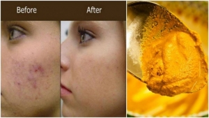 How to Use Turmeric for pimple