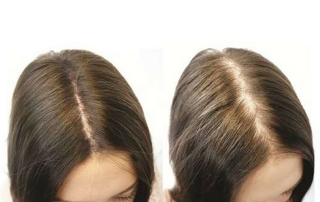 How to Stop Hair Fall and Promote Re-growth