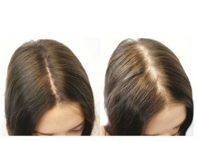How to Stop Hair Fall and Promote Re-growth